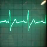 ECG